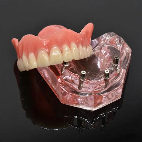 Di Overdenture Di Modeli Kar Labilir I Mandibular Alt Di Modeli Di