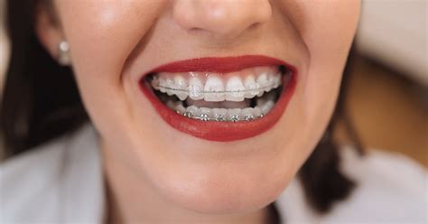 Mild Gingivitis With Braces