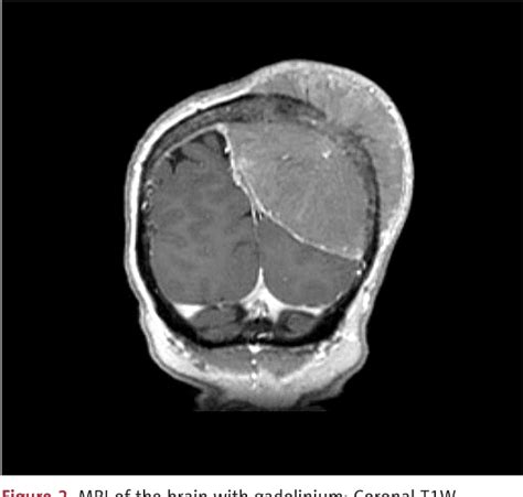 Figure From Anaplastic Meningioma Presenting As A Left Parietal Mass