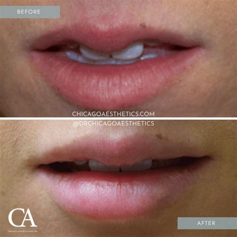 Enhancing Your Smile With Lip Fillers Chicago