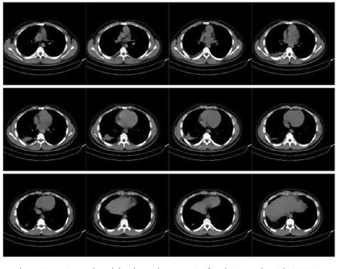 Figure From Treatment Of Chronic Tuberculous Empyema By Intrapleural