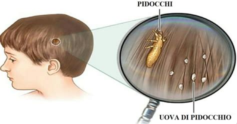 Come Non Prendere I Pidocchi Info Causadeipidocchi