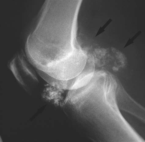 Sonographic Appearance Of Primary Synovial Chondromatosis Of The Knee