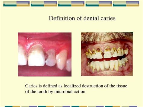 Ppt Microbiology Of Dental Caries Powerpoint Presentation Free