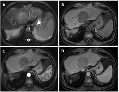 Mosaic Architecture Fat Suppressed T2 Weighted Image A Pre B And