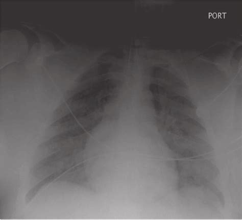 Portable Ap Chest Radiograph On Day 2 Download Scientific Diagram