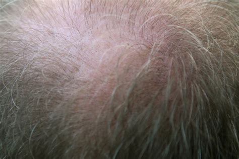 Las Causas De La Ca Da Del Cabello En Los Hombres Y C Mo Prevenir Su