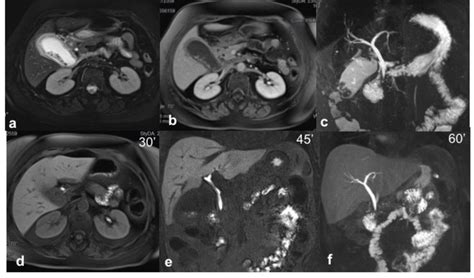 Biliary And Vascular Iatrogenic Lesions After Laparoscopic