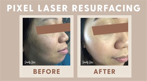 Why Try Pixel Laser Resurfacing — Simply Skin