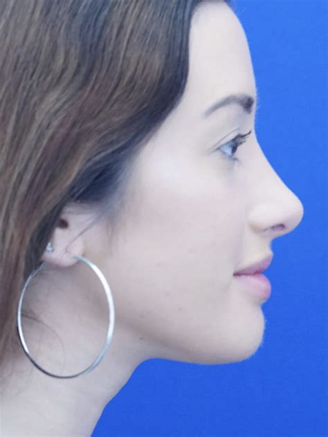 Prominent Nose Closed Rhinoplasty