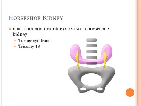 PPT - Horseshoe Kidney PowerPoint Presentation, free download - ID:3008130