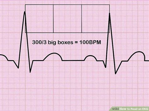 How To Read Ekg Strips Change Comin