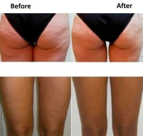 Cellulite And Thighs Aesthetics Face And Bodysculpting