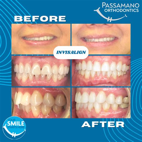 Black Triangle Reduction With Invisalign Passamano Orthodontics