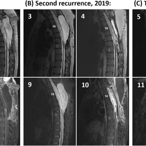 Representative Slices Of Sagittal Thoracic Spine Mri T Weighted