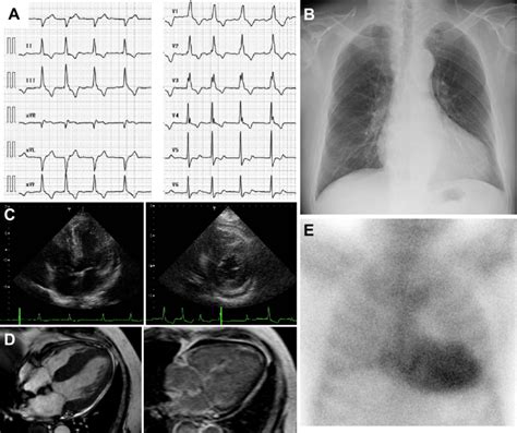 Figure1 A An Electrocardiogram B Chest X Ray And C