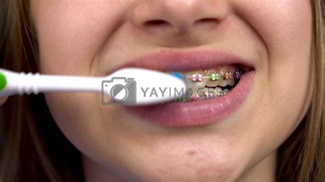 Girl With Braces Brush Her Teeth With A Toothbrush Closeup A Girl With