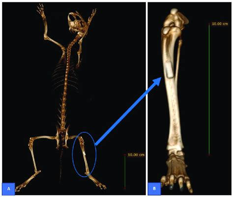 Postoperative Control Ct Scan Reconstruction Was Obtained To Confirm