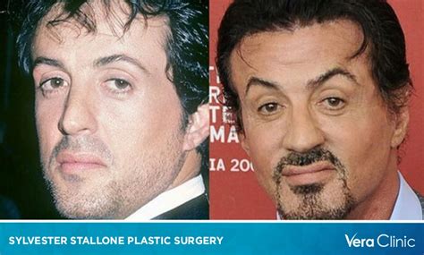 Sylvester Stallone Plastic Surgery: Age-Defying Appearance