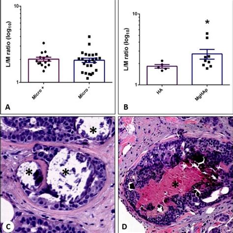 Mtc Tc Sestamibi Uptake In Breast Cancer A Image Shows