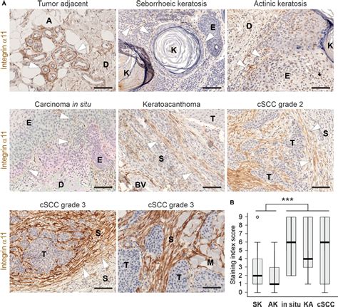 Frontiers Upregulated integrin α11 in the stroma of cutaneous