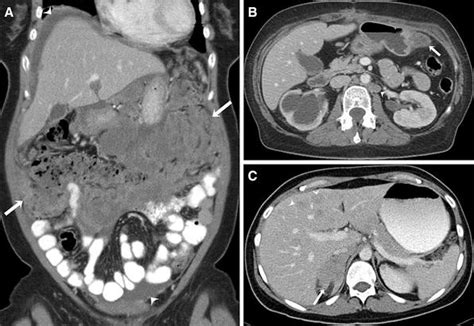 Representative Examples Of Metastatic Adenocarcinoma Of The Cervix A