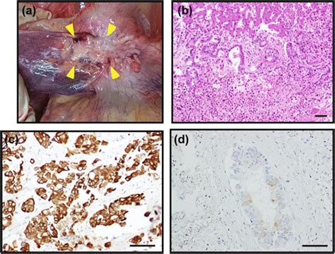 Postmortem Findings Macroscopically A Solid Tumor Arrowheads In The