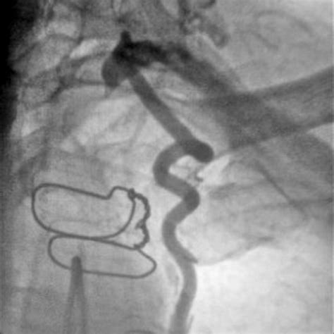 Angiography Of Post Angioplasty Control With Stent Implant Showing Good