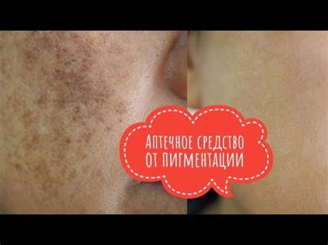 Аптечное средство ОТ ПИГМЕНТАЦИИ. Дешевое средство от пигментных пятен ...