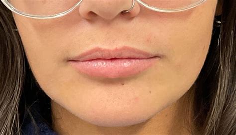 Dermal Filler – Juvederm Ultra (lips) Before & After Gallery - Case 4977