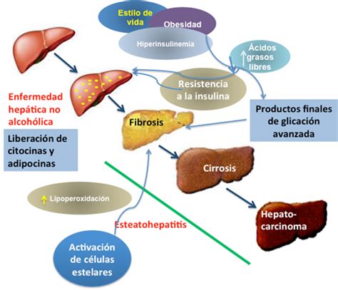 Hígado Graso Y Esteatohepatitis No Alcohólica Patogénesis Y