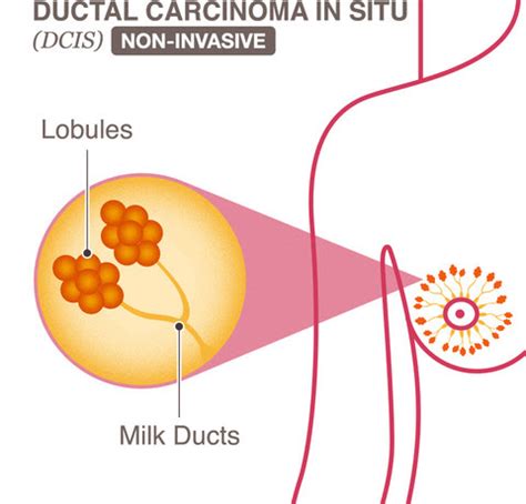 Invasive Ductal Carcinoma stages