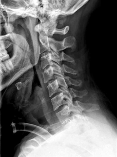 Cervical Spine Xray