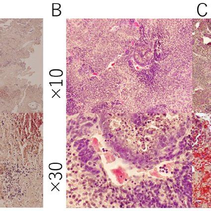 Hematoxylin Eosin Staining Of The Section From The Tumor Derived From