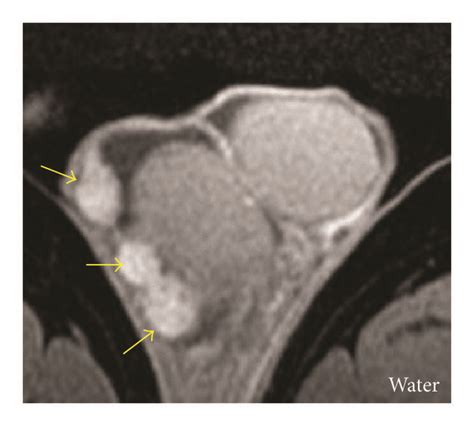 Imaging Of The Fibrous Pseudotumor In The Scrotum Scrotal Ultrasound