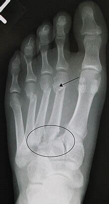 Lisfranc injury - Wikipedia