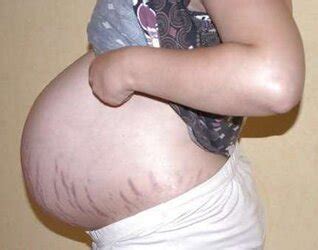 Vergeture Grossesse ZB Porn