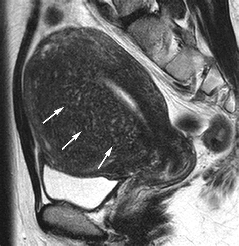 Information MR Imaging Findings of Adenomyosis: Correlation with Histopathologic News