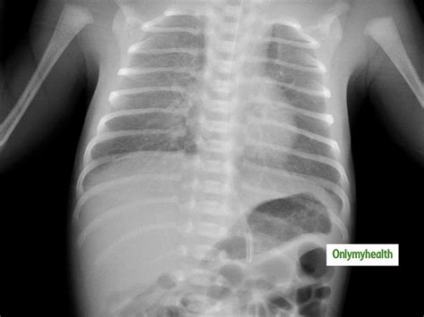 All About Respiratory Distress Syndrome: Diagnosis, Treatment and ...