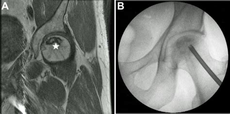 Magnetic Resonance Image From A Patient With An Avascular Necrosis