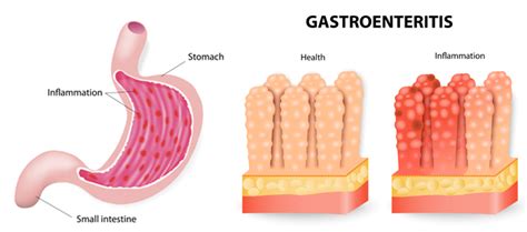 La Gastroenteritis