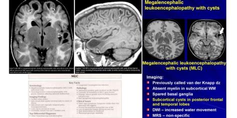 Pediatric White Matter Disease