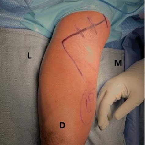 Pdf Return To Play After Distal Biceps Tendon Repair