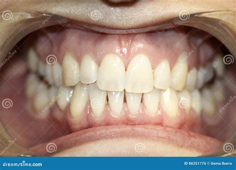 Open Mouth With Dental Opener Stock Photo Image Of Human Medical