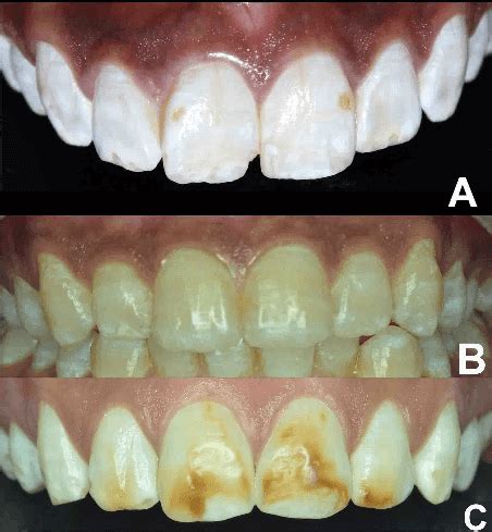 How To Cure Fluorosis Management Of Stained Fluorotic Teeth By