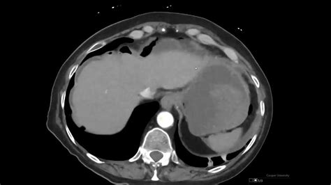 Gastric pylorus peptic ulcer perforation CT - YouTube