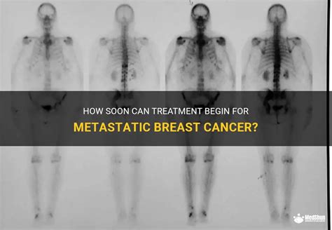 How Soon Can Treatment Begin For Metastatic Breast Cancer Medshun