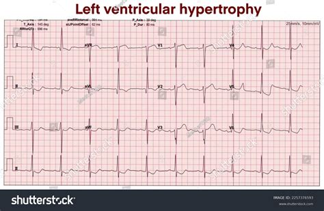 Electrocardiogram Show Left Ventricular Hypertrophy Heart Stock