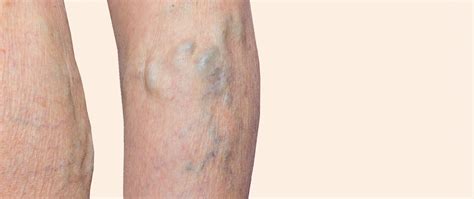 Chirurgia Delle Vene Varicose Con Laser Endovenoso Clinica Domus