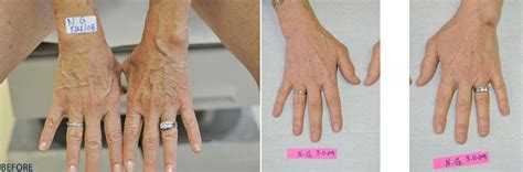 Hand Vein Treatment in Orange County | CA Vein Specialists